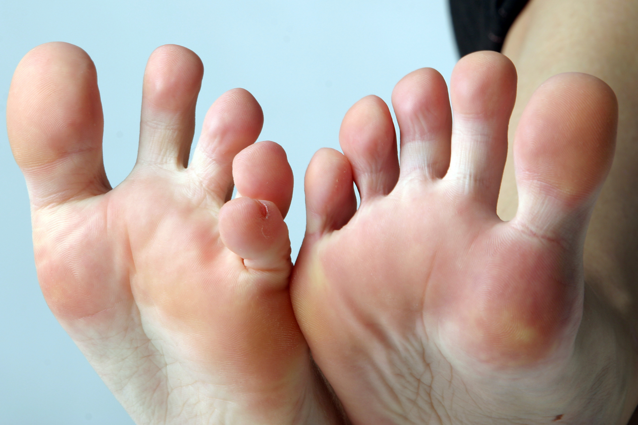A woman's feet with two toes.
