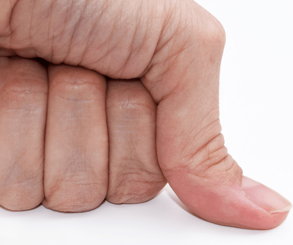 Image showing a hypermobile thumb joint